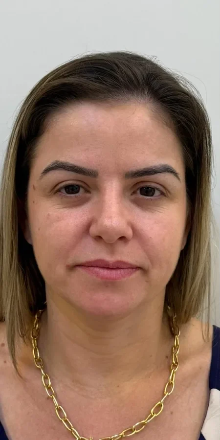 Pele antes do protocolo para melasma