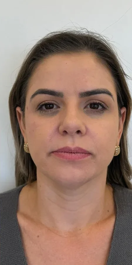 Pele depois do protocolo para melasma
