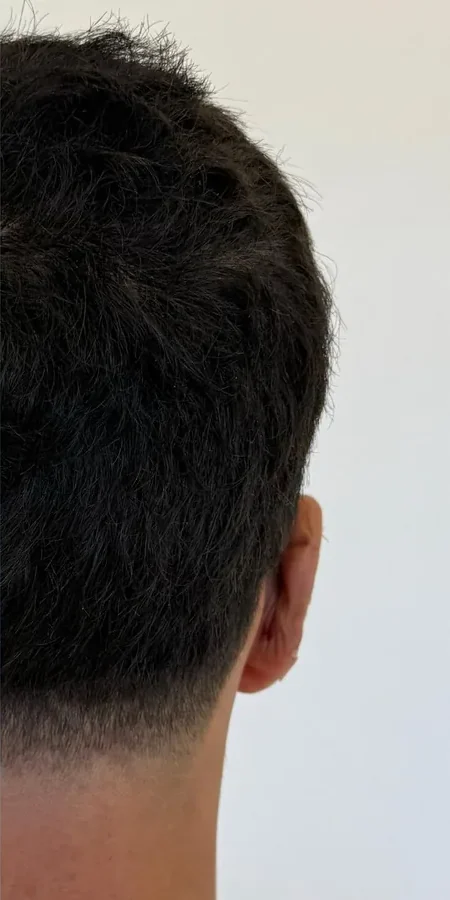 Orelha depois da otomodelação