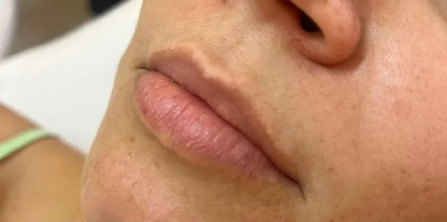 Lábios antes do preenchimento labial