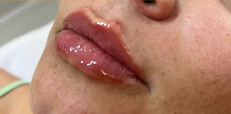 Lábios depois do preenchimento labial