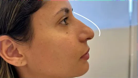 Perfil antes da rinomodelação