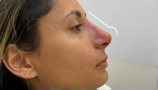 Perfil depois da rinomodelação
